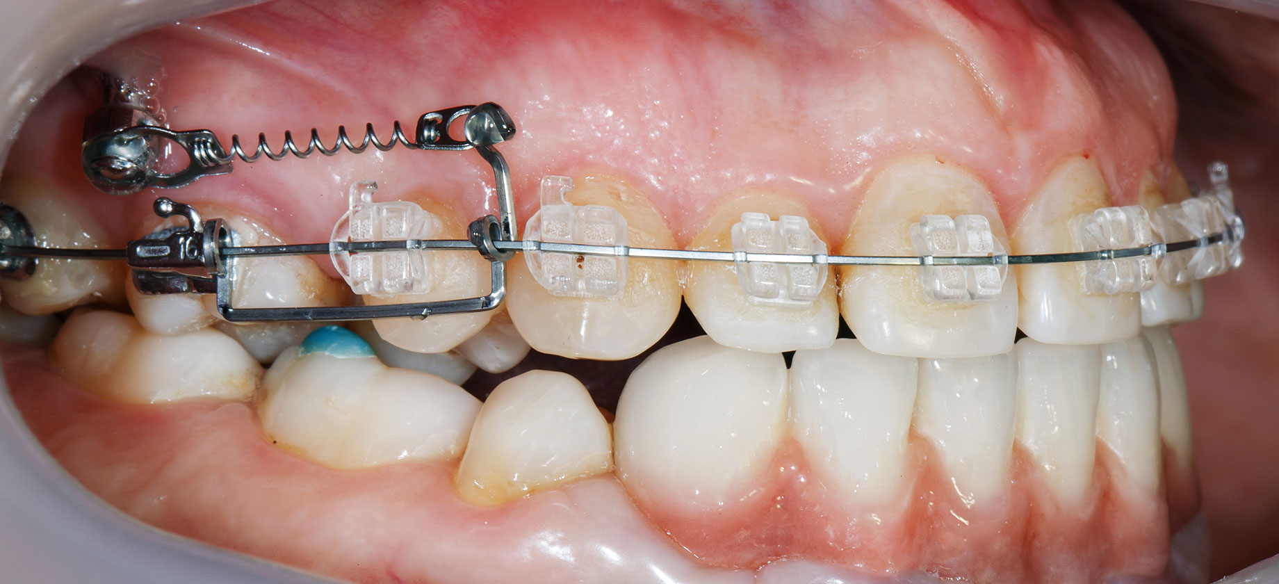 矯正用アンカースクリューを使用した矯正歯科治療